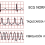 ondas-ecg.jpg