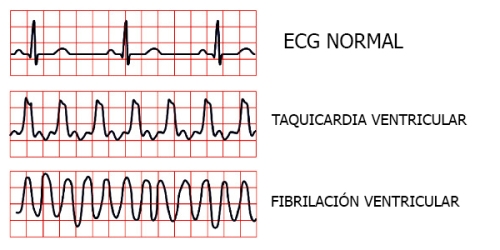 ondas-ecg.jpg