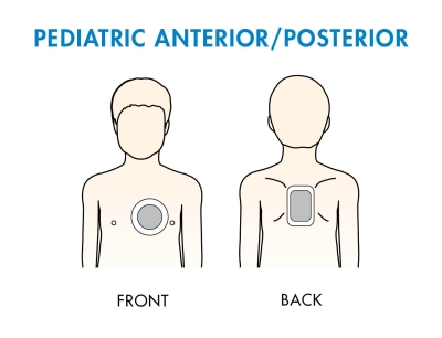 padplacement_pedi_anteriorposterior.jpg